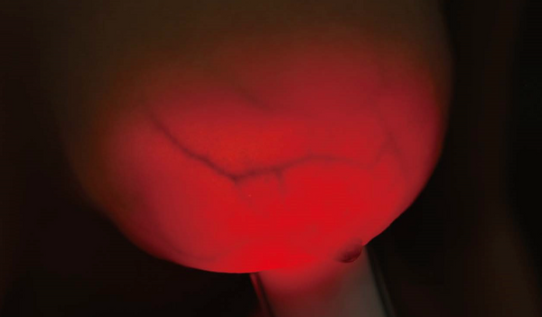 Dispositivo Luminous Breast Pro Series: Porque la detección temprana salva vidas 